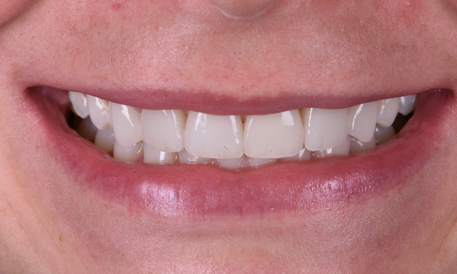 Close-up of an individual patient's smile after cosmetic dental treatment