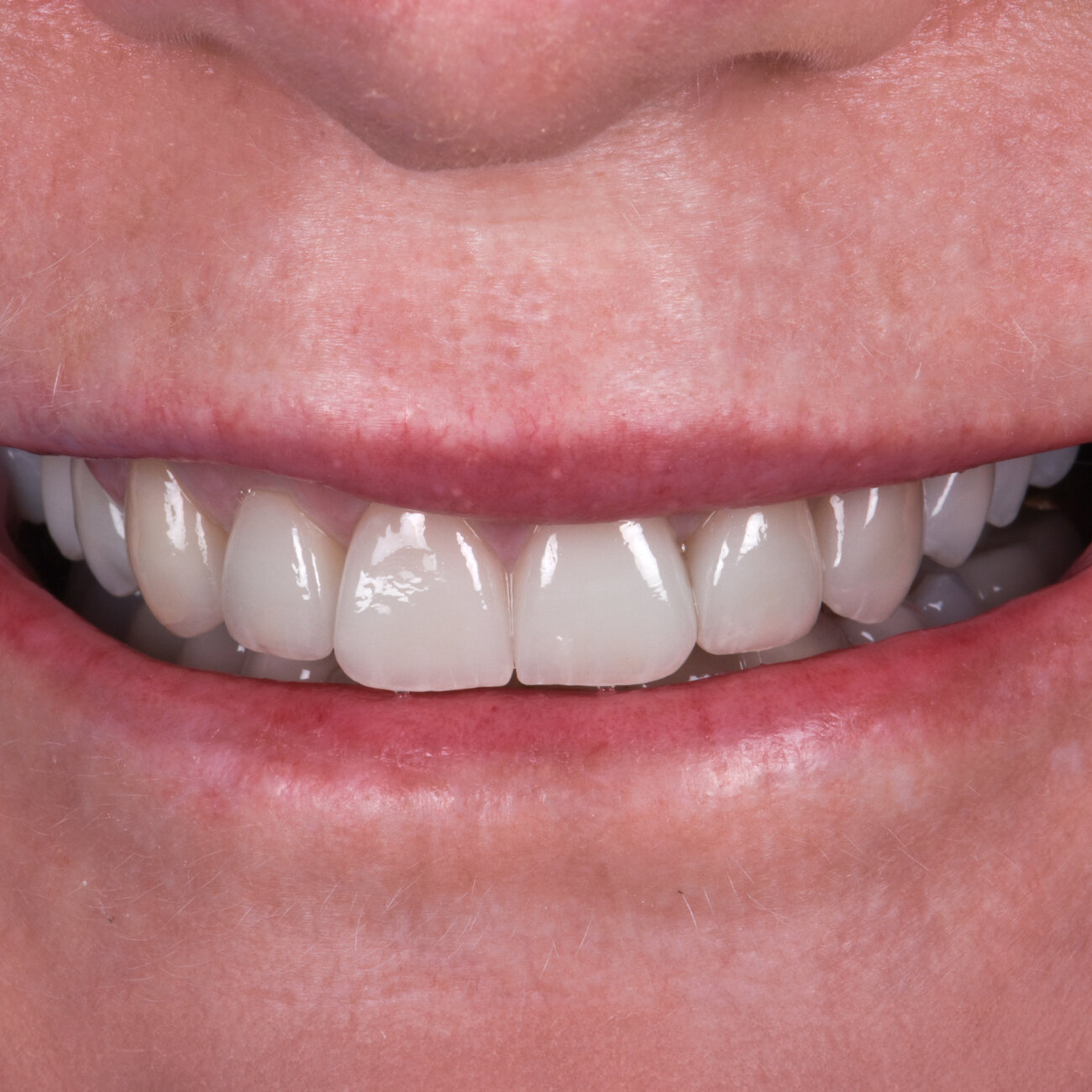 My Implant Dentist patient after cosmetic dental treatment