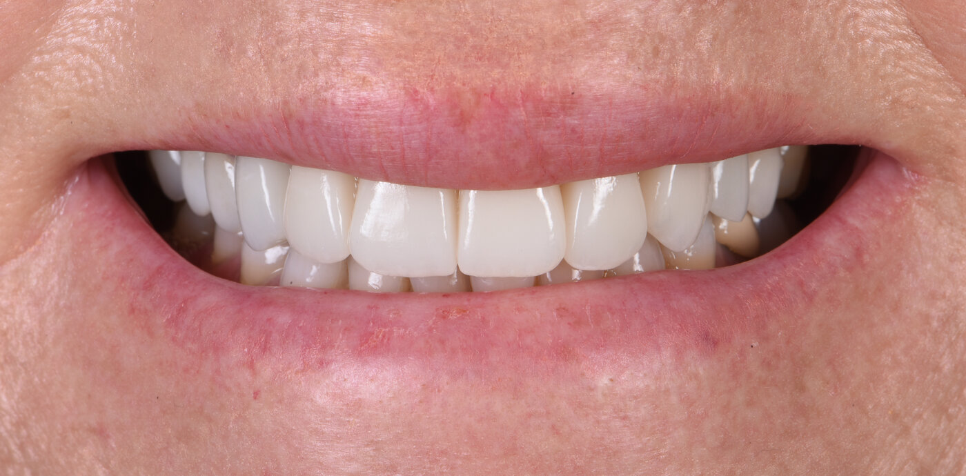 Before and after of a porcelain veneers patient at My Implant Dentist